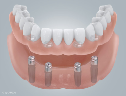 Schematische Darstellung eines zahnlosen Unterkiefers mit implantatverankerter Prothese
