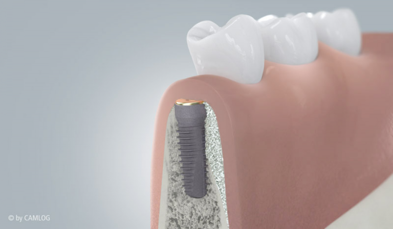 zahnmedizinisches Implantat mit Knochenaugmentation